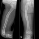 Paediatric Femur Fracture 6 months